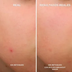 IT COSMETICS Bye Bye Breakout Sérum